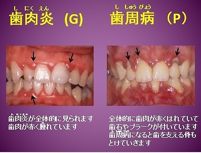 歯肉 炎 治療