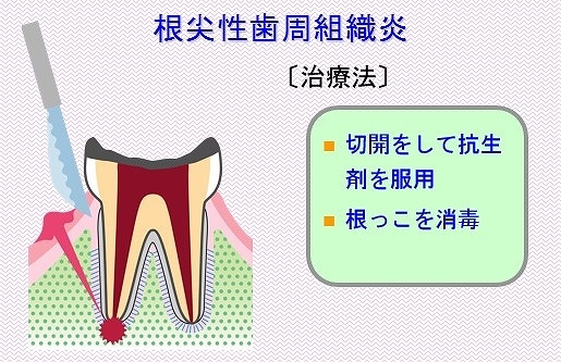 根尖性歯周組織炎の治療法