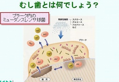 虫歯の痛みや原因を知ろう